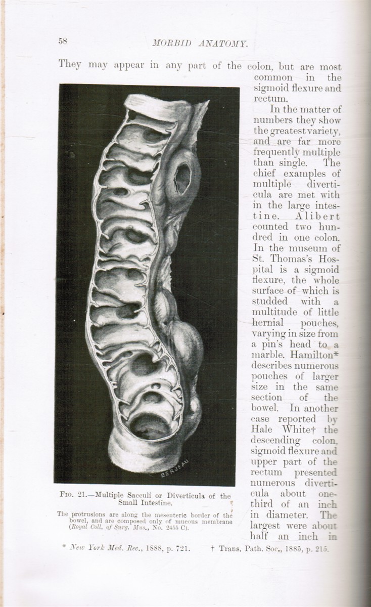 TREVES, FREDRICK - Intestinal Obstruction: Its Varieties with Their Pathology, Diagnosis, and Treatment